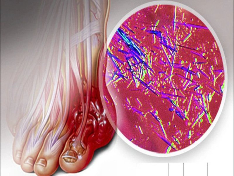 Acid uric là sản phẩm của quá trình chuyển hóa tự nhiên của cơ thể