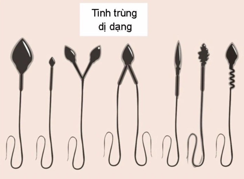 Tinh trùng dị dạng có ảnh hưởng như thế nào?