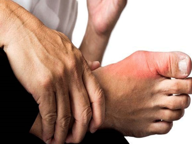 Nồng độ axit uric tăng cao trong thời gian dài có thể gây ra bệnh gout
