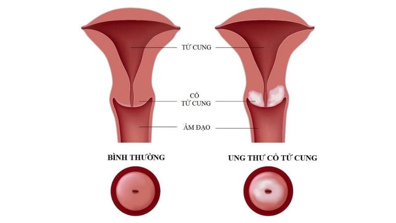 Ung thư cổ tử cung ảnh hưởng đến sinh sản