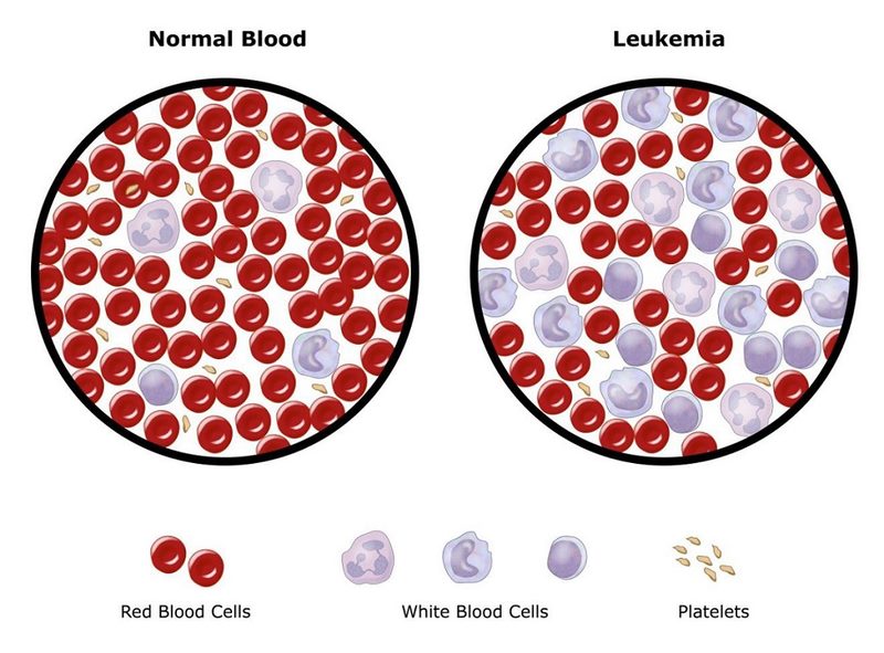 Leukemia, hay còn gọi là bệnh bạch cầu