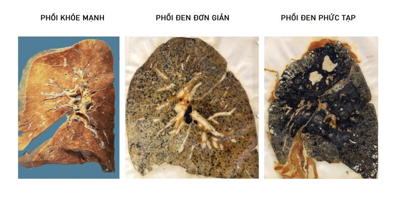 Cách điều trị bệnh phổi đen