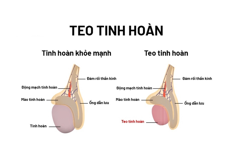 Biến chứng teo tinh hoàn của bệnh quai