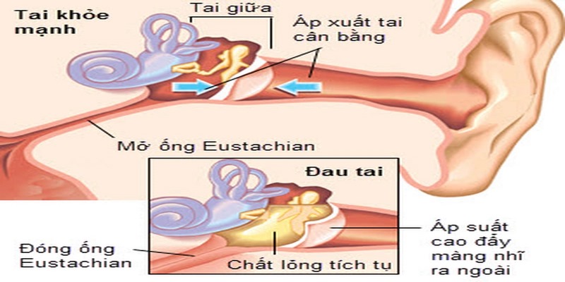 Khi nào cần phẫu thuật viêm tai giữa? Bạn cần biết