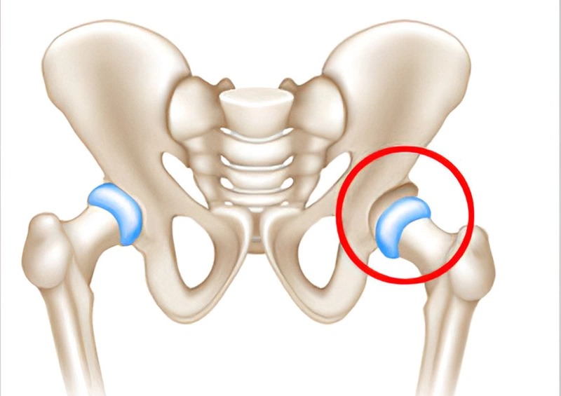 Trật khớp háng là một chấn thương nghiêm trọng