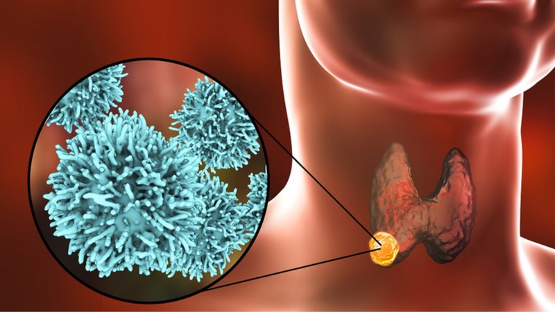 Chia sẻ biện pháp phòng ngừa các loại bệnh lý tuyến giáp