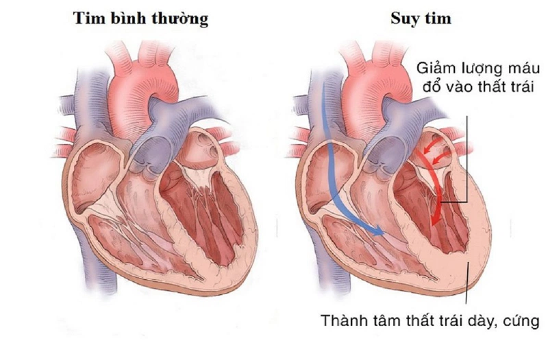 Triệu chứng của khó thở về đêm