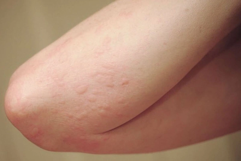 Nổi mề đay (urticaria) là một phản ứng dị ứng của da