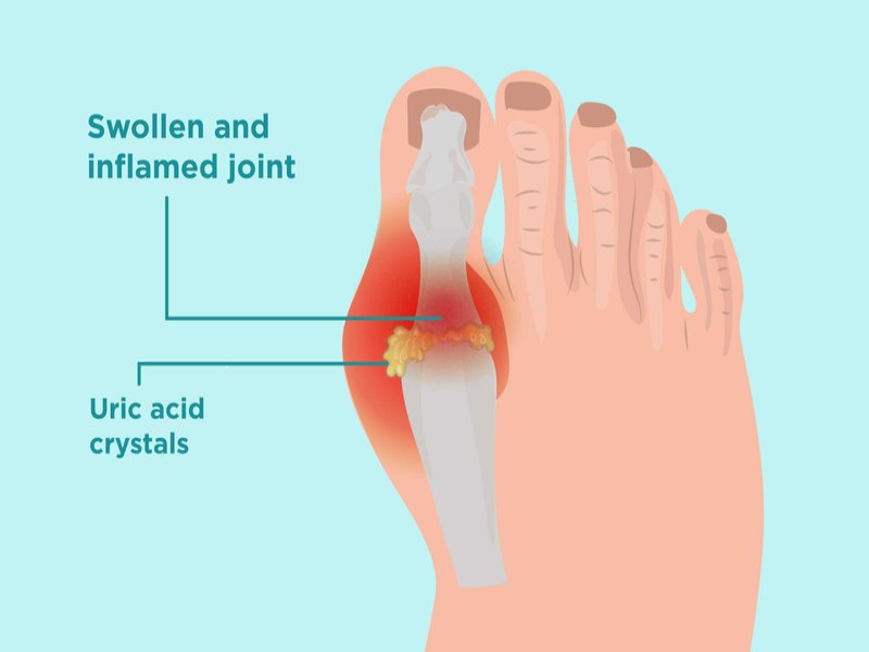 Tăng acid uric máu là tình trạng chỉ số acid uric trong máu tăng cao bất thường