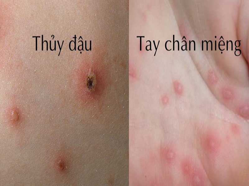 Phân biệt bệnh thủy đậu và tay chân miệng ở trẻ em cụ thể