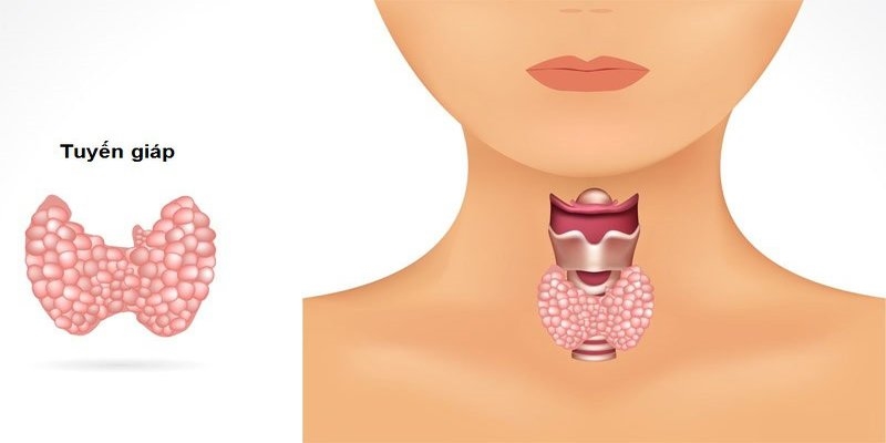 Điều trị carcinom tuyến giáp dạng nhú