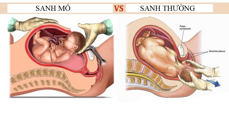 Sinh mổ dưới sự chỉ định của bác sĩ