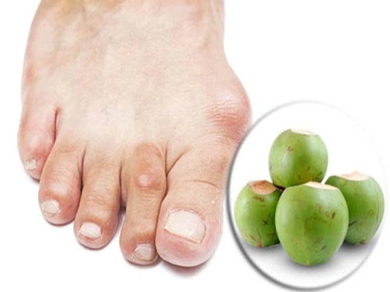 Những lưu ý khi dùng nước dừa chữa gout