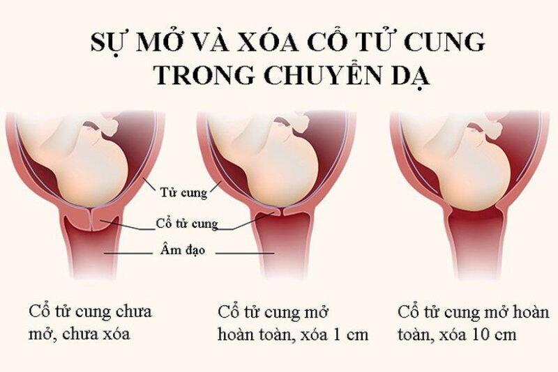 Dấu hiệu nhận biết chuyển dạ bình thường