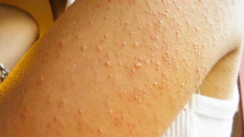 Keratosis Pilaris (KP), còn gọi là "da gà"