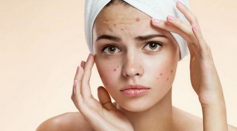 Nhiều người thắc mắc tại sao da dầu dùng dầu tẩy trang bị nổi mụn