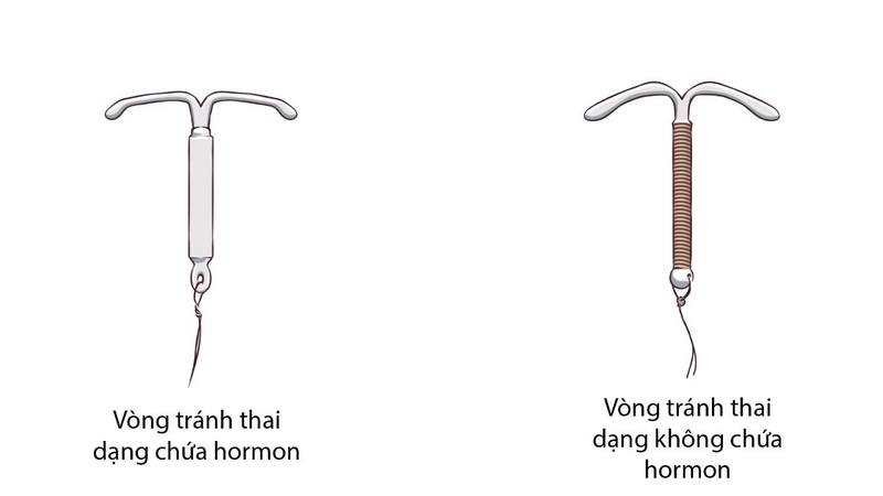 Vòng tránh thai có hình dạng chữ T