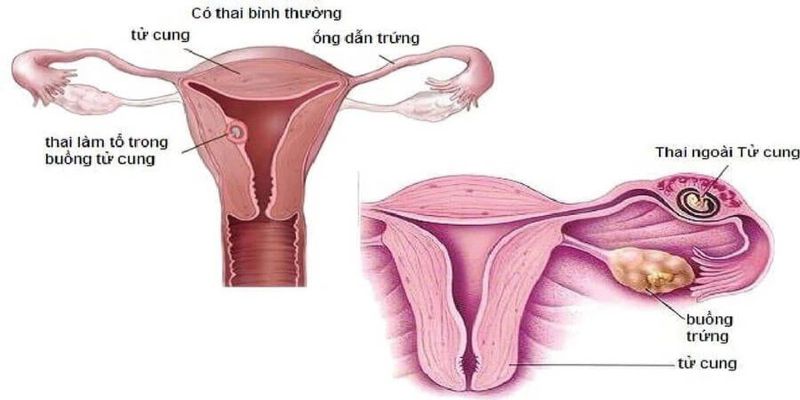 Đau bụng dưới khi mang thai do thai nhi làm tổ trong tử cung