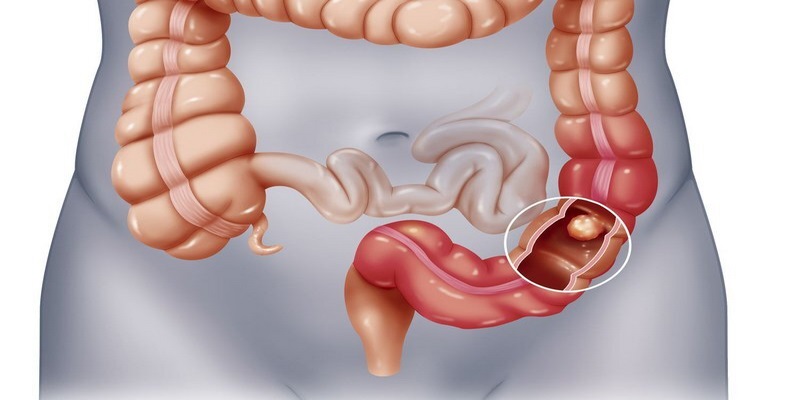 Tắc ruột có thể gây nhiễm trùng nặng và tử vong nếu không cấp cứu sớm