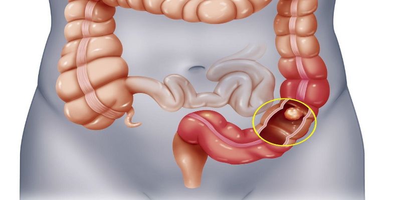 Đau ruột già cũng có thể gây khó chịu ở vùng bụng trên bên phải