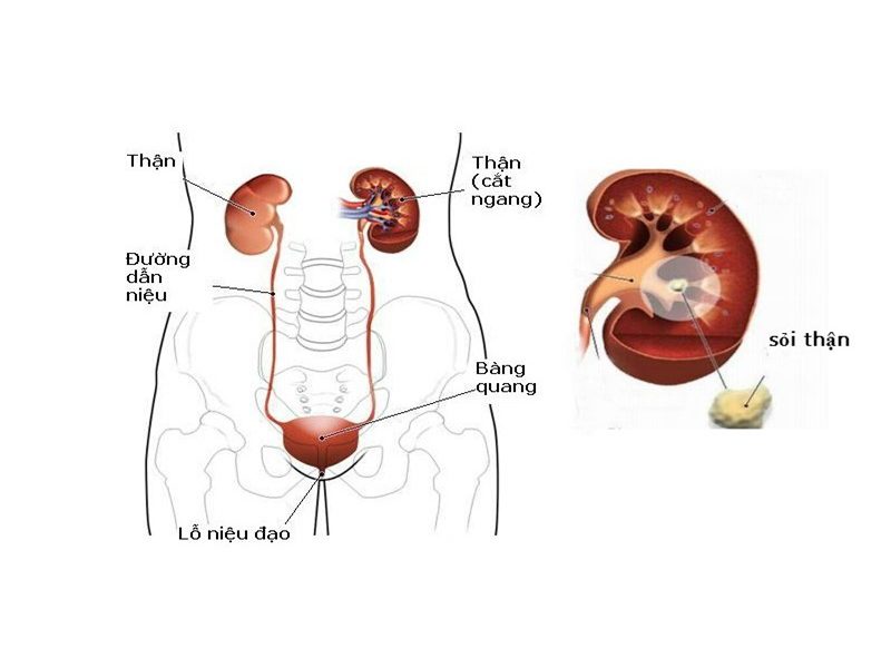 Khi bị sỏi tiết niệu phía bên trái, người bệnh thường bị đau bụng, đau thắt lưng hoặc vùng bẹn cùng bên