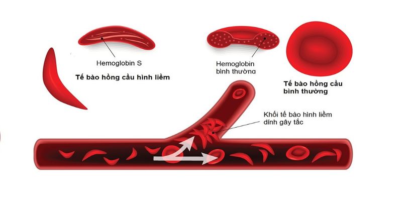 Thiếu máu hồng cầu hình liềm