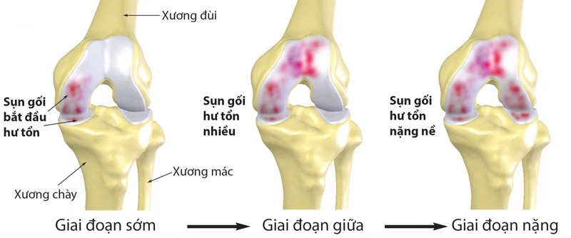 Trình tự chẩn đoán và điều trị đau khớp gối