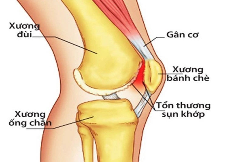 Cơn đau khớp gối không chỉ gây khó chịu mà còn hạn chế khả năng vận động