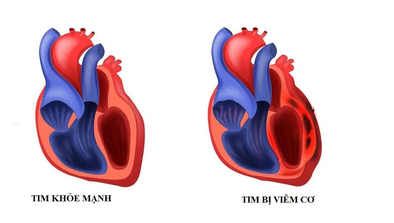 Viêm cơ tim có thể gây ra rối loạn nhịp tim