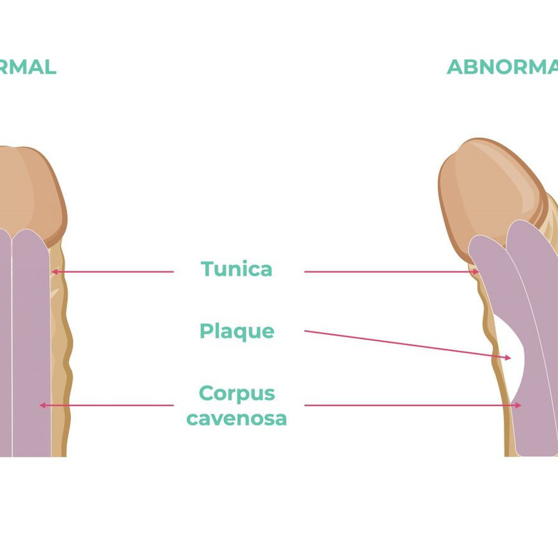 Dương vật cong là tình trạng dương vật không thẳng