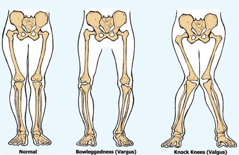 Các dị tật về cấu trúc là một trong những yếu tố nguy cơ của gai khớp gối