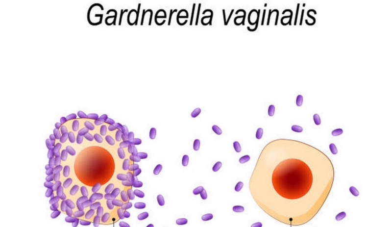 Thông tin về vi khuẩn Gardnerella Vaginalis