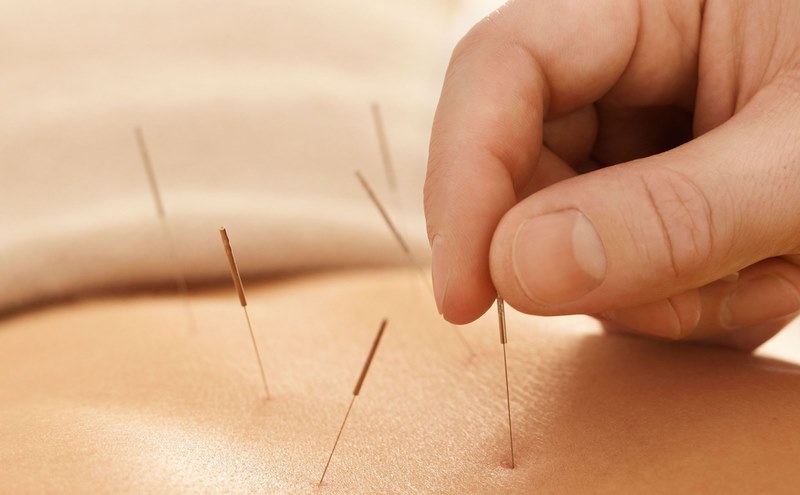Châm cứu giúp kích thích các điểm huyệt trên cơ thể để giảm đau 