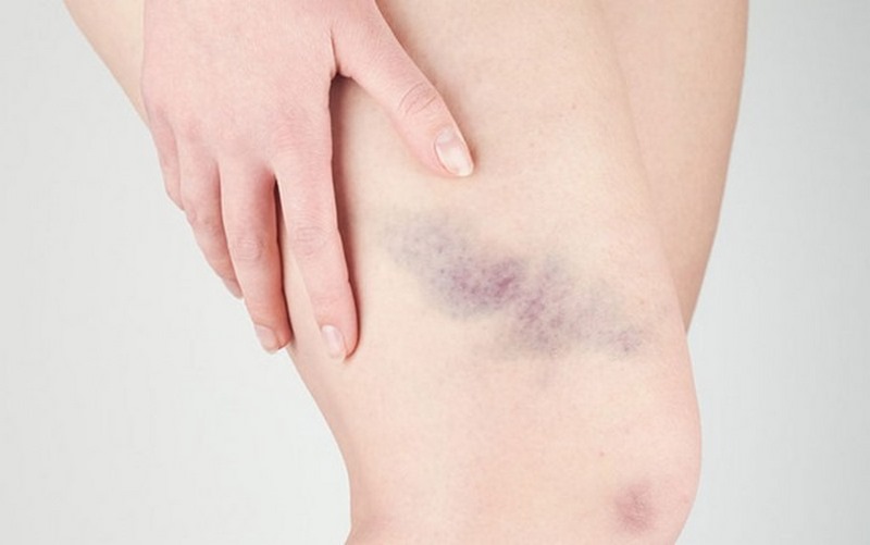 Điều trị chính cho Hemophilia B là liệu pháp thay thế yếu tố IX