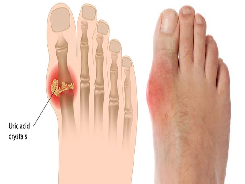 Hình ảnh bệnh gout giai đoạn 2