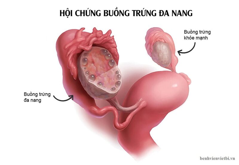 Tìm hiểu chung về hội chứng buồng trứng đa nang