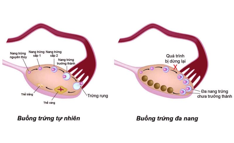 Nguyên nhân gây hội chứng buồng trứng đa nang