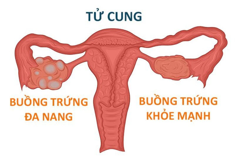 Dùng thuốc để can thiệp hội chứng đa nang buồng trứng