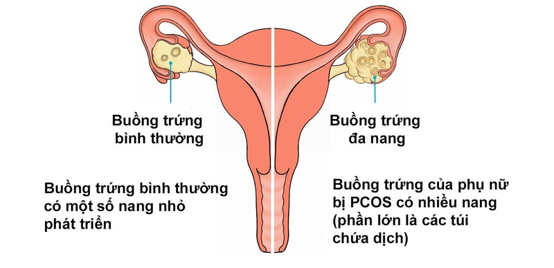 Bệnh buồng trứng đa nang ảnh hướng đến sức khỏe sinh sản