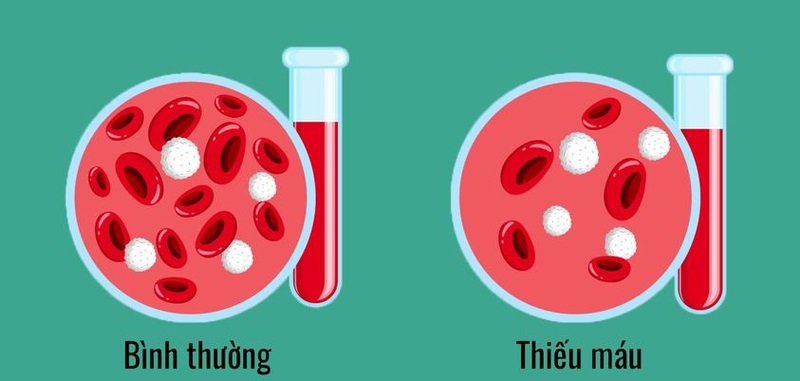 Có nhiều nguyên nhân có thể gây ra tình trạng huyết sắc tố thấp