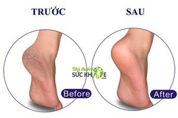 Kem Hỗ Trợ Cải Thiện Nứt Gót Chân Neutrogena Foot cream 56g