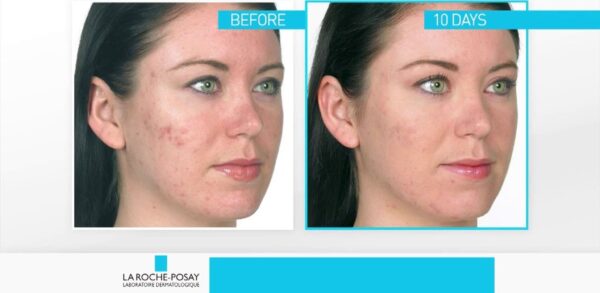 Kem Hỗ Trợ Cải Thiện Mụn La Roche Posay Effaclar Duo+