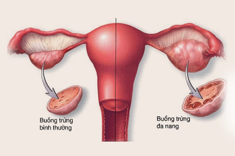 Kích thước buồng trứng là gì?