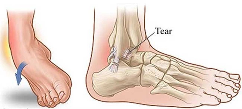 Lật cổ chân có thể xảy ra do nhiều nguyên nhân khác nhau