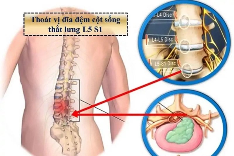 Phẫu thuật không loại bỏ hoàn toàn đĩa đệm thoát vị