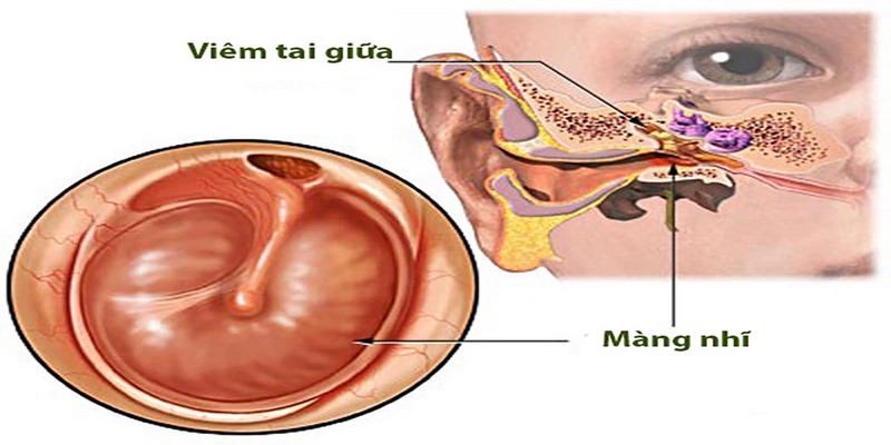 Phẫu thuật được chỉ định khi viêm tai giữa không đáp ứng với điều trị bằng thuốc