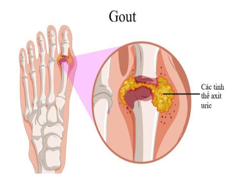 Bệnh gout thường xảy ra ở ngón chân cái