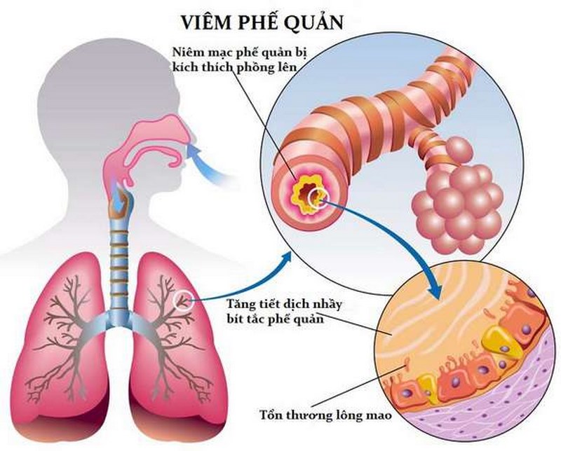 Triệu chứng của viêm phế quản cấp tính ở trẻ em