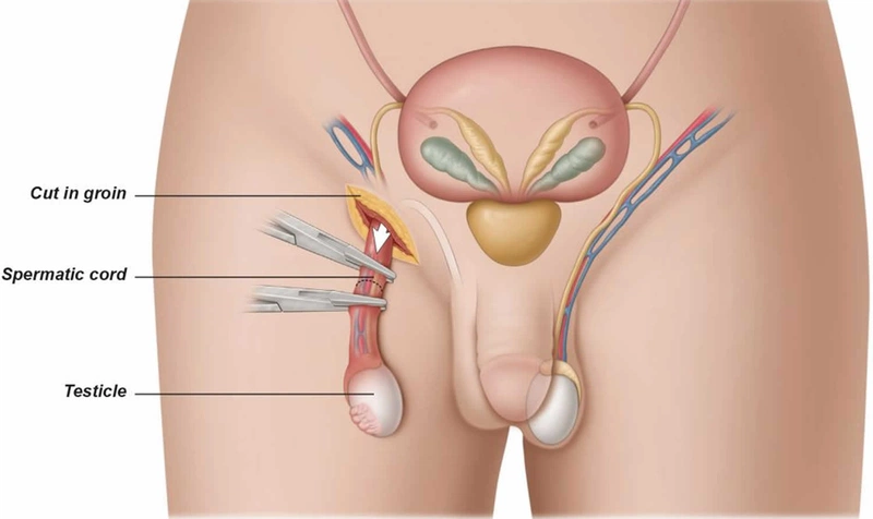 Dấu hiệu nhận biết tinh hoàn ẩn ở nam