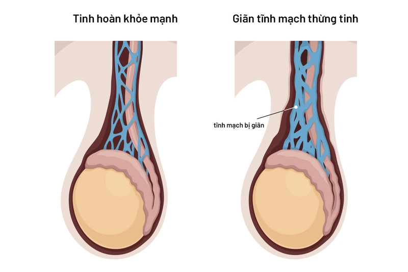 Tinh hoàn chảy xệ là hiện tượng gì